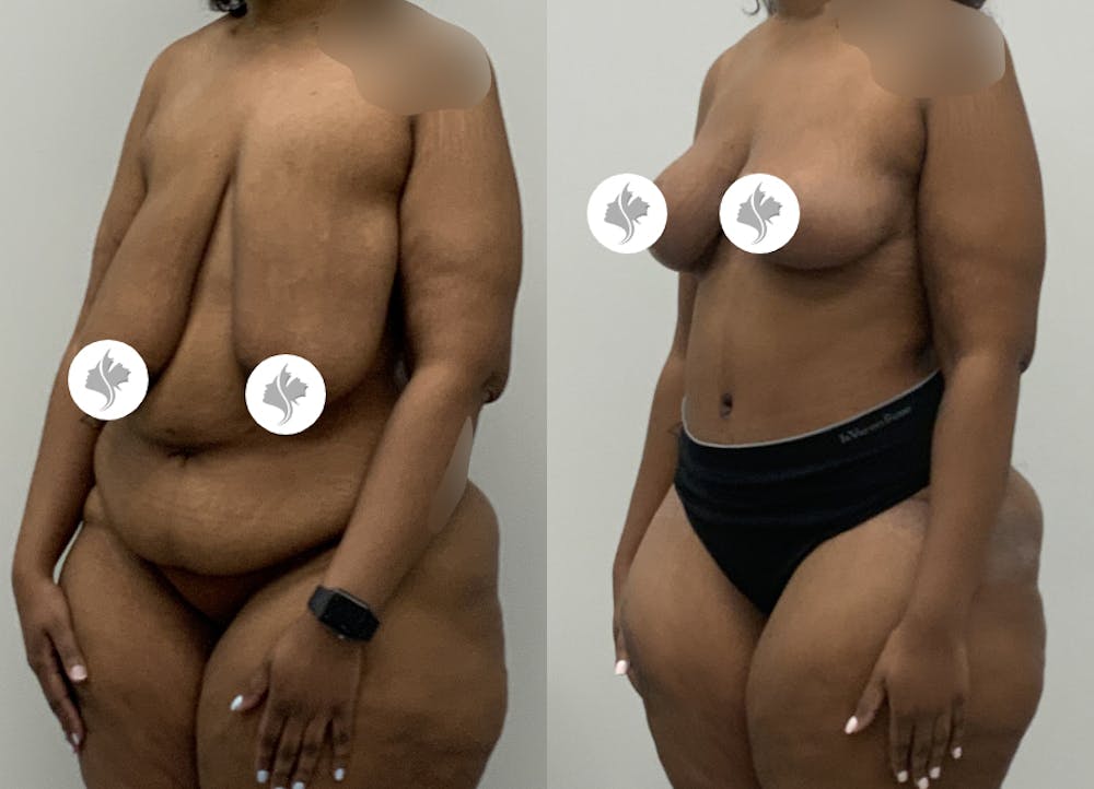 This is one of our beautiful post-bariatric body contouring patient #59