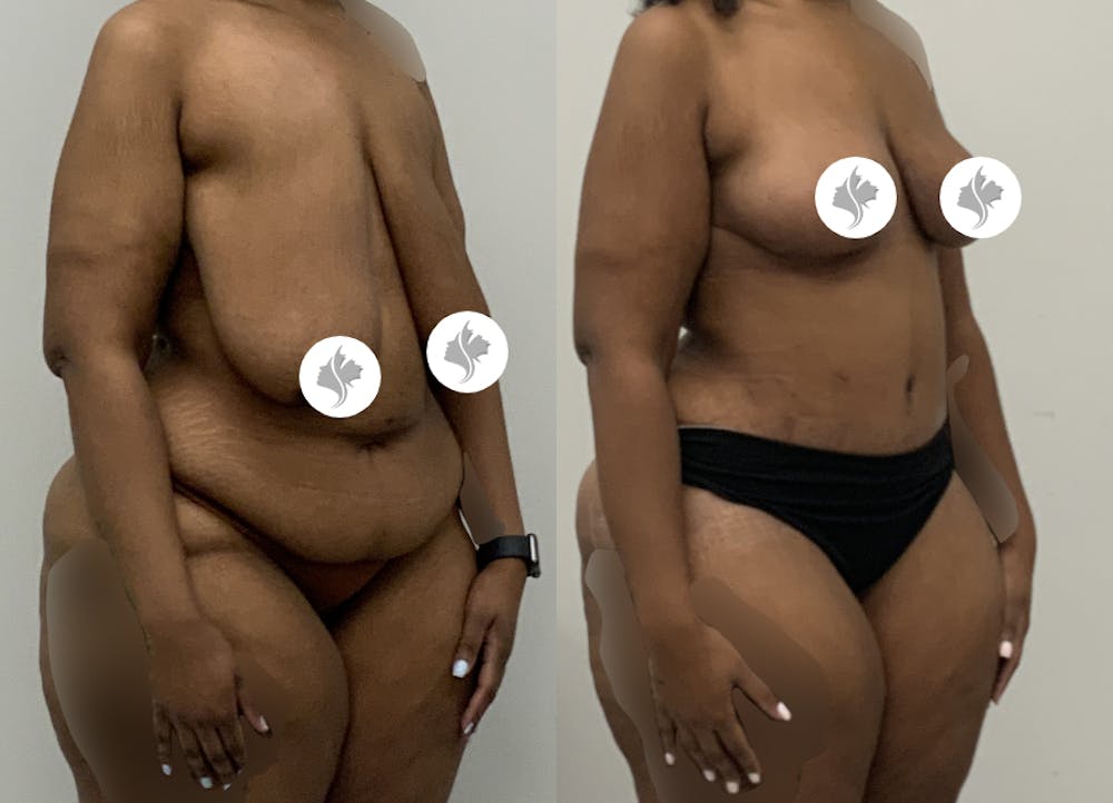 This is one of our beautiful post-bariatric body contouring patient #59