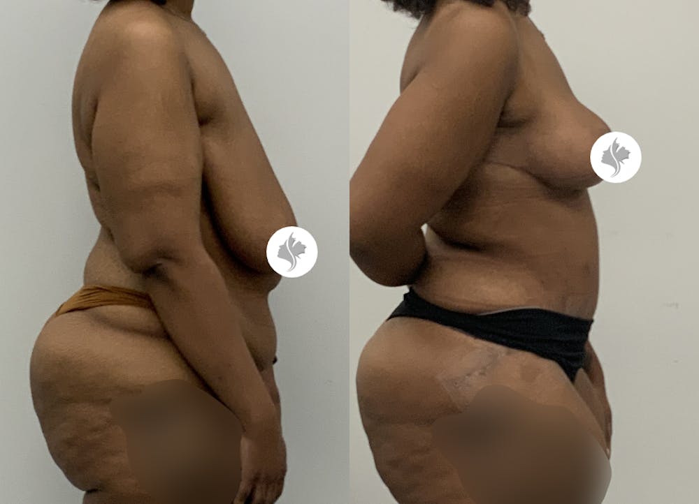 This is one of our beautiful post-bariatric body contouring patient #59