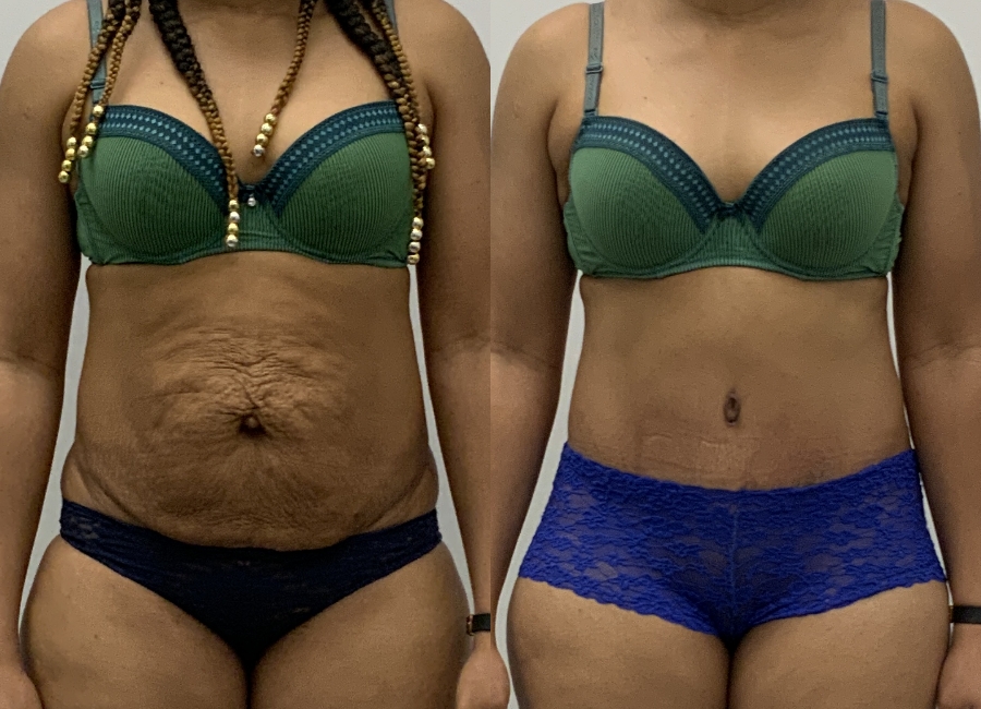 This is one of our beautiful tummy tuck patient 16