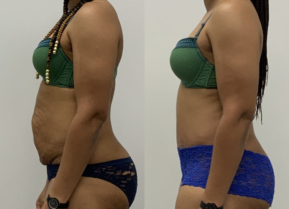 This is one of our beautiful tummy tuck patient #10