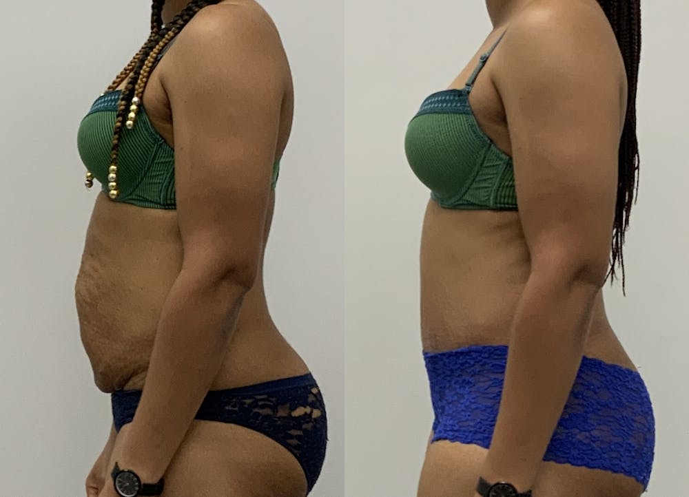 This is one of our beautiful tummy tuck patient #16