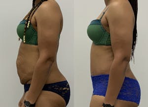 This is one of our beautiful tummy tuck patient 10