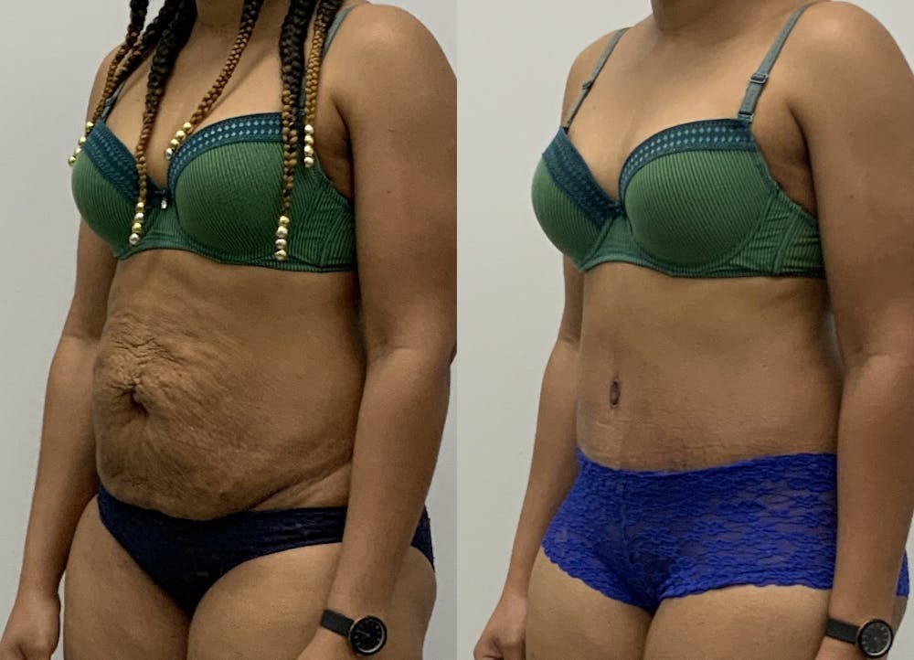 This is one of our beautiful tummy tuck patient #16