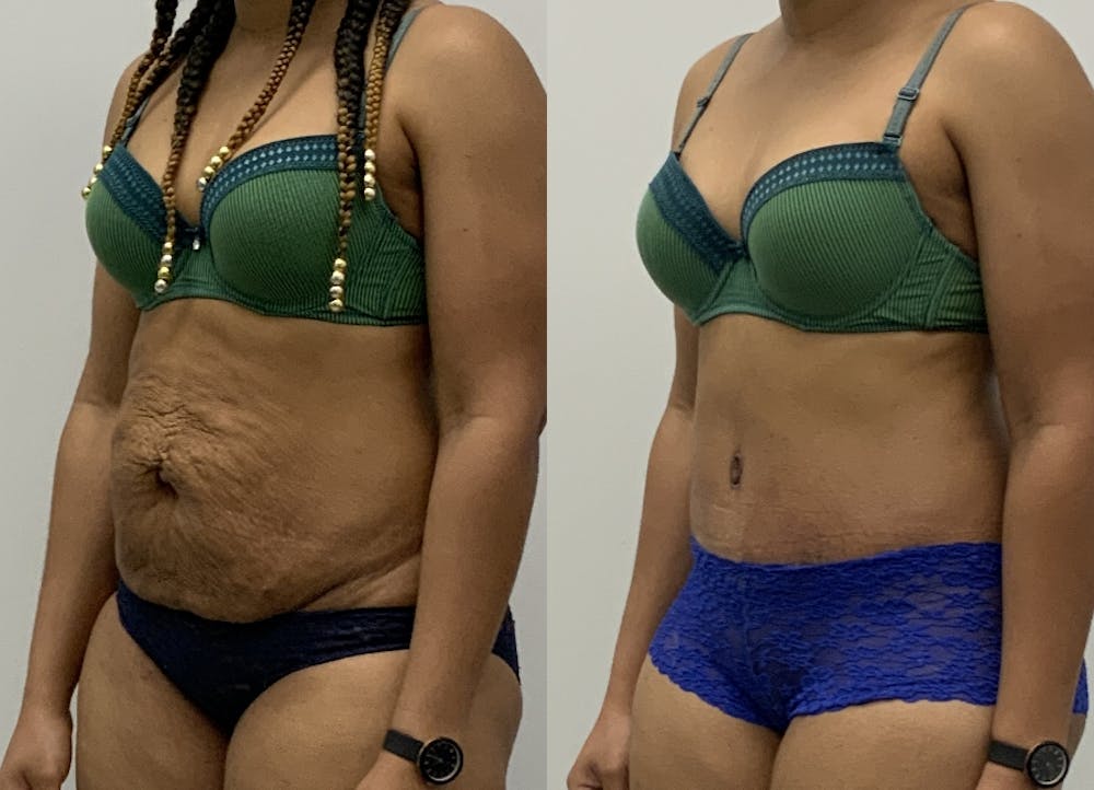 This is one of our beautiful tummy tuck patient #10