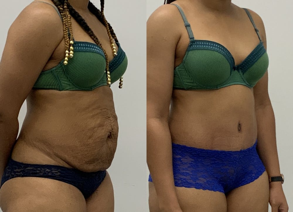 This is one of our beautiful tummy tuck patient #10