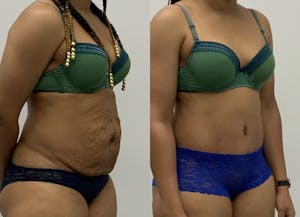 This is one of our beautiful tummy tuck patient 10