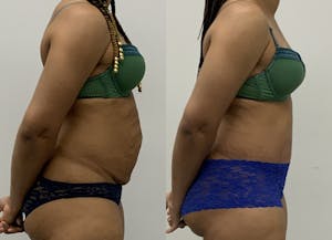 This is one of our beautiful tummy tuck patient 10