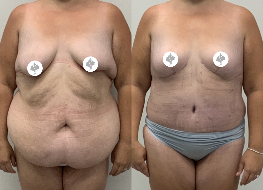 This is one of our beautiful post-bariatric body contouring patient 60