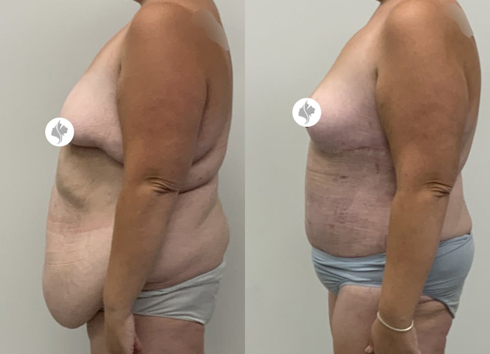 This is one of our beautiful tummy tuck patient #110