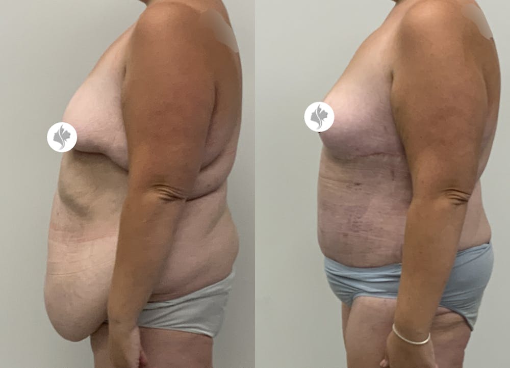 This is one of our beautiful tummy tuck patient #102