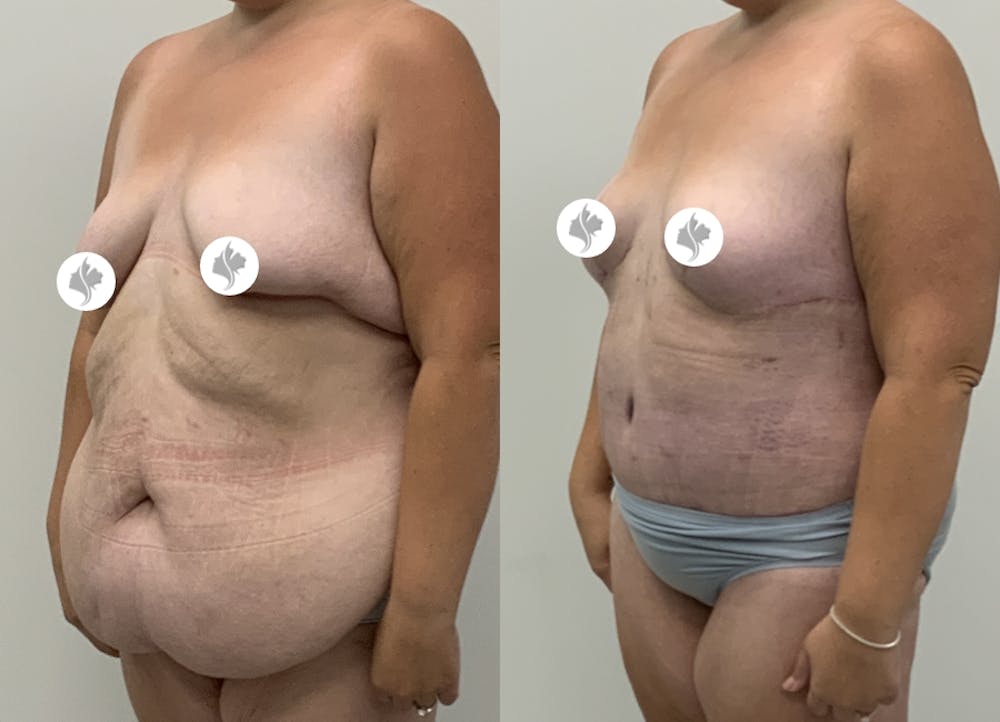 This is one of our beautiful tummy tuck patient #110