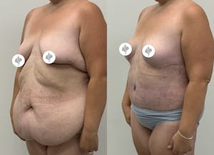 This is one of our beautiful post-bariatric body contouring patient 60