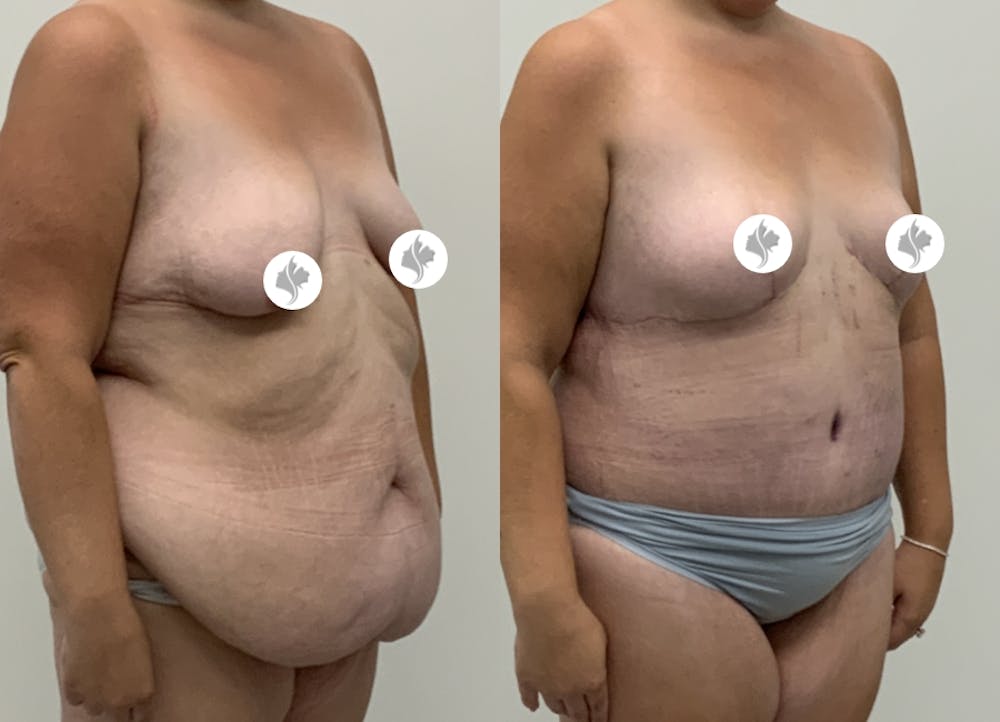This is one of our beautiful post-bariatric body contouring patient #60