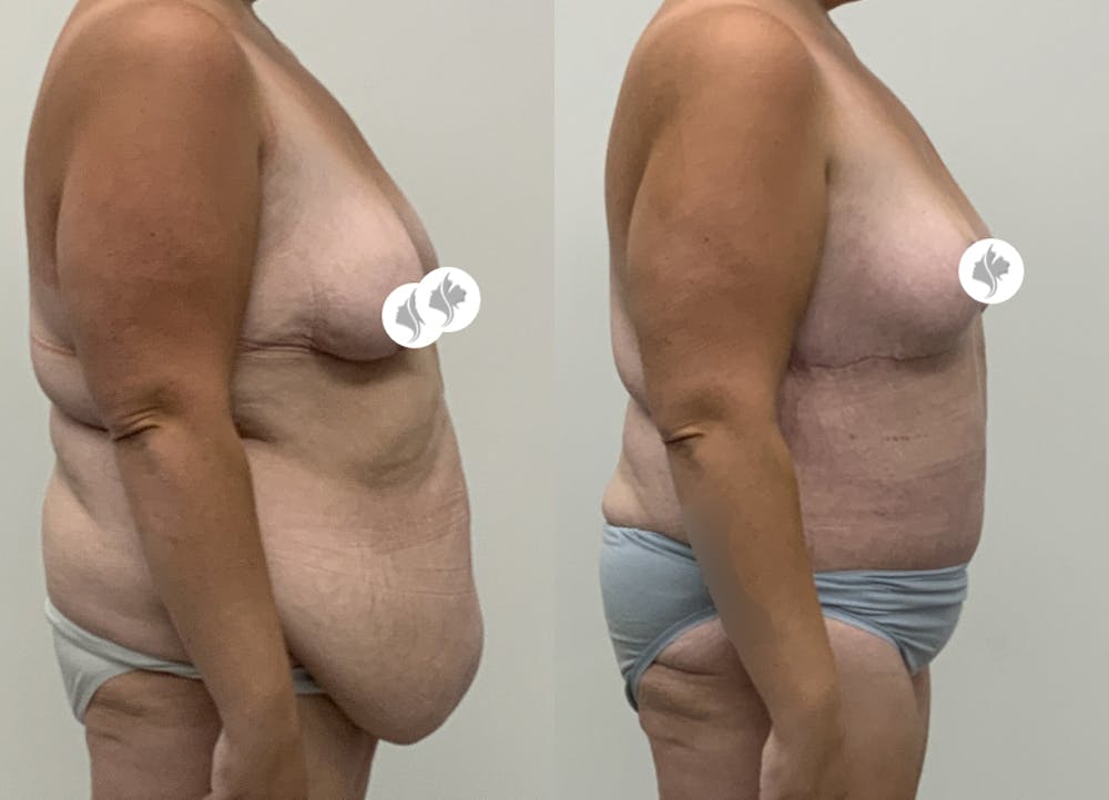 This is one of our beautiful post-bariatric body contouring patient #60