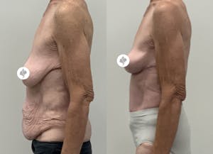 This is one of our beautiful tummy tuck patient 103