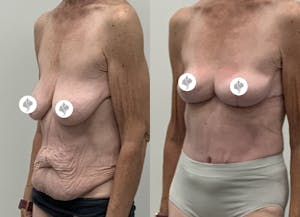 This is one of our beautiful tummy tuck patient 103