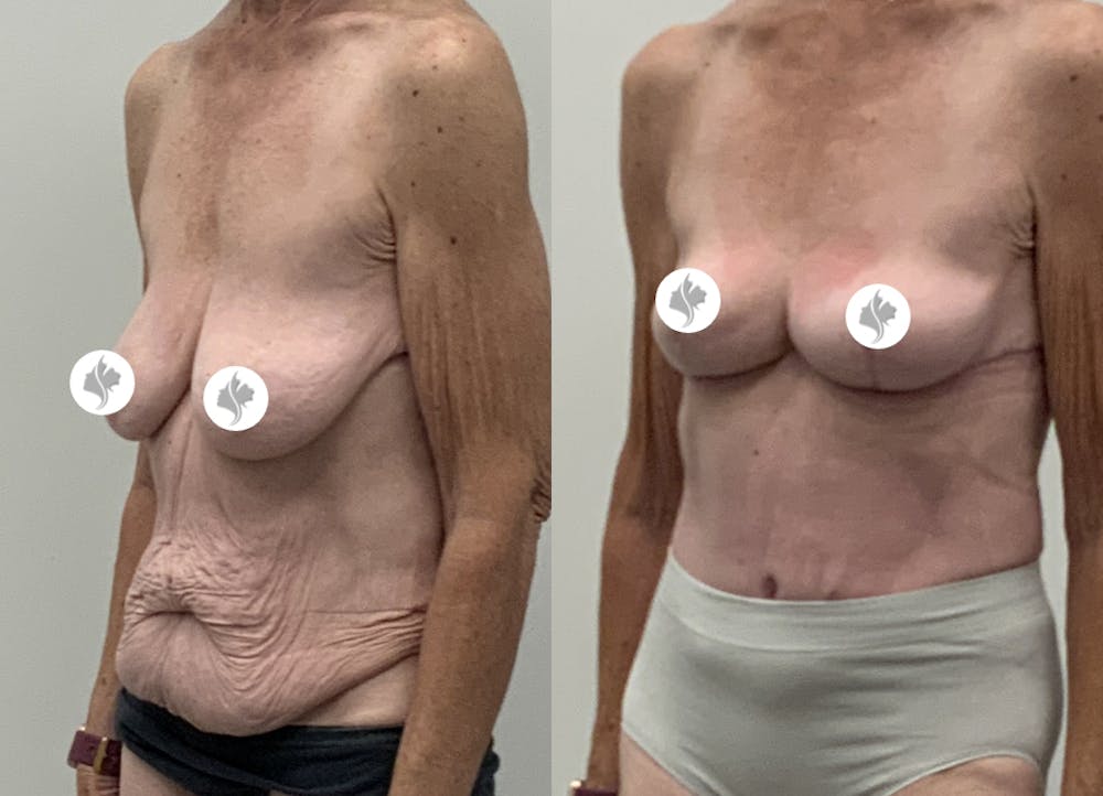 This is one of our beautiful tummy tuck patient #103