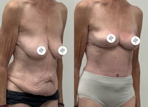 This is one of our beautiful tummy tuck patient 103