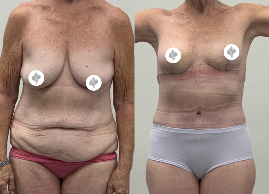 This is one of our beautiful post-bariatric body contouring patient 62