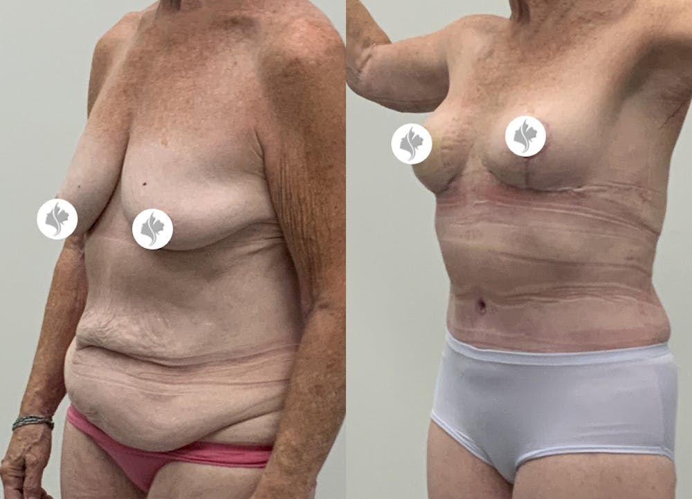 This is one of our beautiful post-bariatric body contouring patient #62