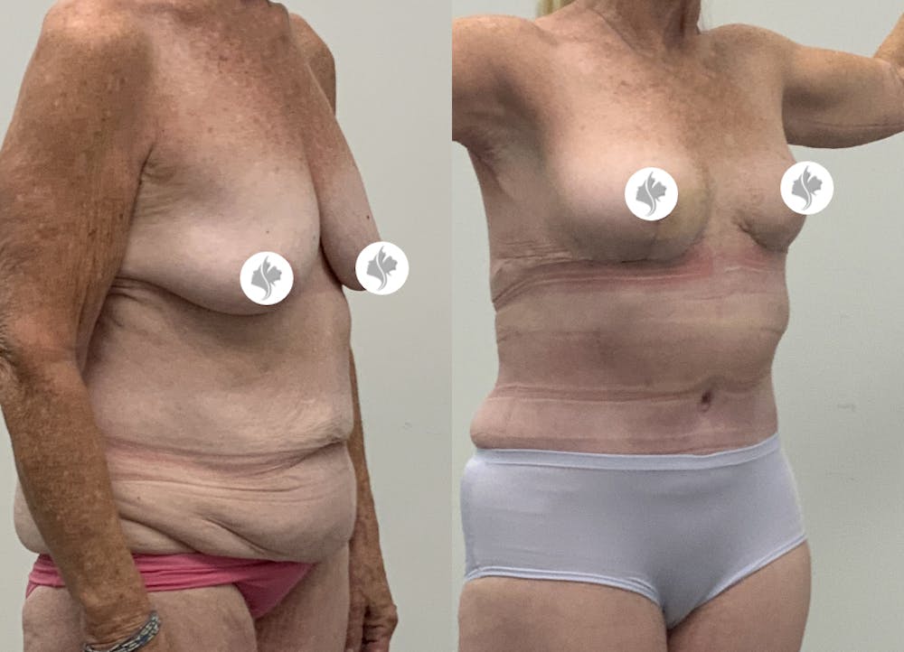 This is one of our beautiful post-bariatric body contouring patient #62