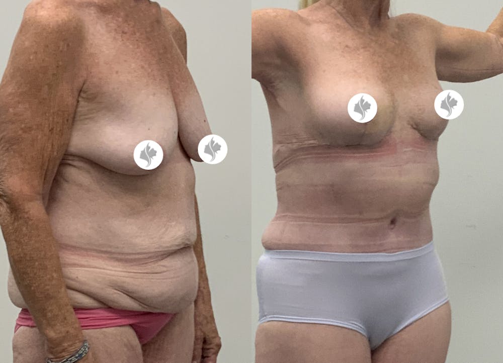 This is one of our beautiful tummy tuck patient #104