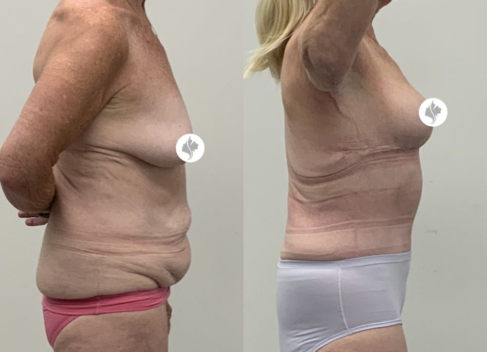This is one of our beautiful post-bariatric body contouring patient #62