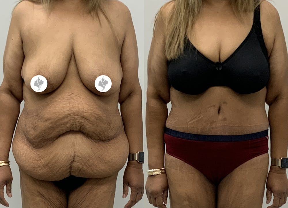 This is one of our beautiful post-bariatric body contouring patient #63