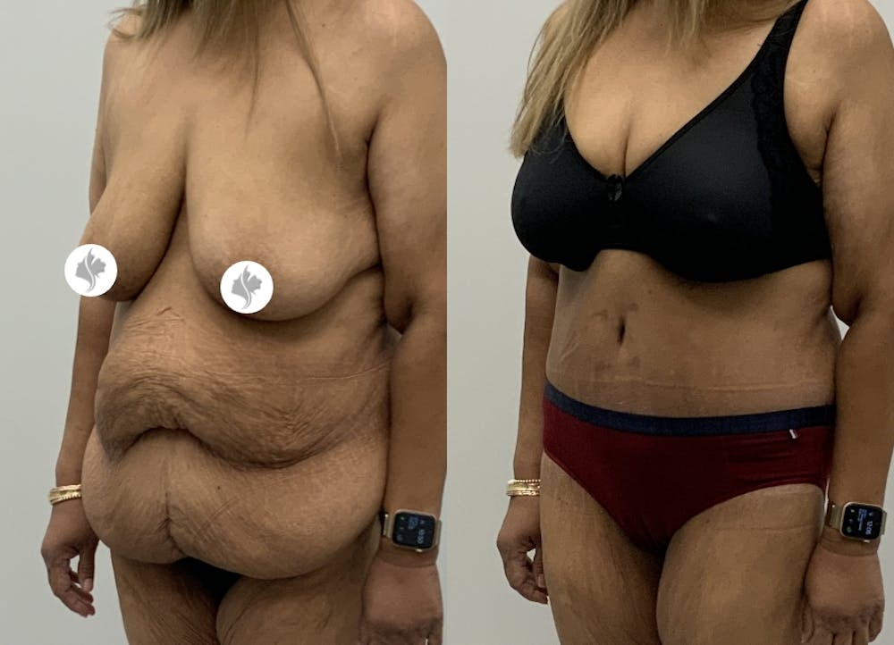 This is one of our beautiful post-bariatric body contouring patient #63