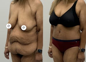 This is one of our beautiful post-bariatric body contouring patient 63