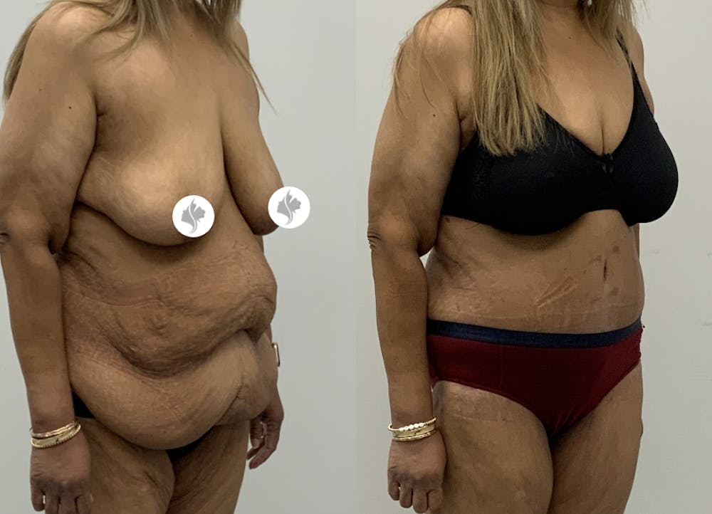 This is one of our beautiful tummy tuck patient #105