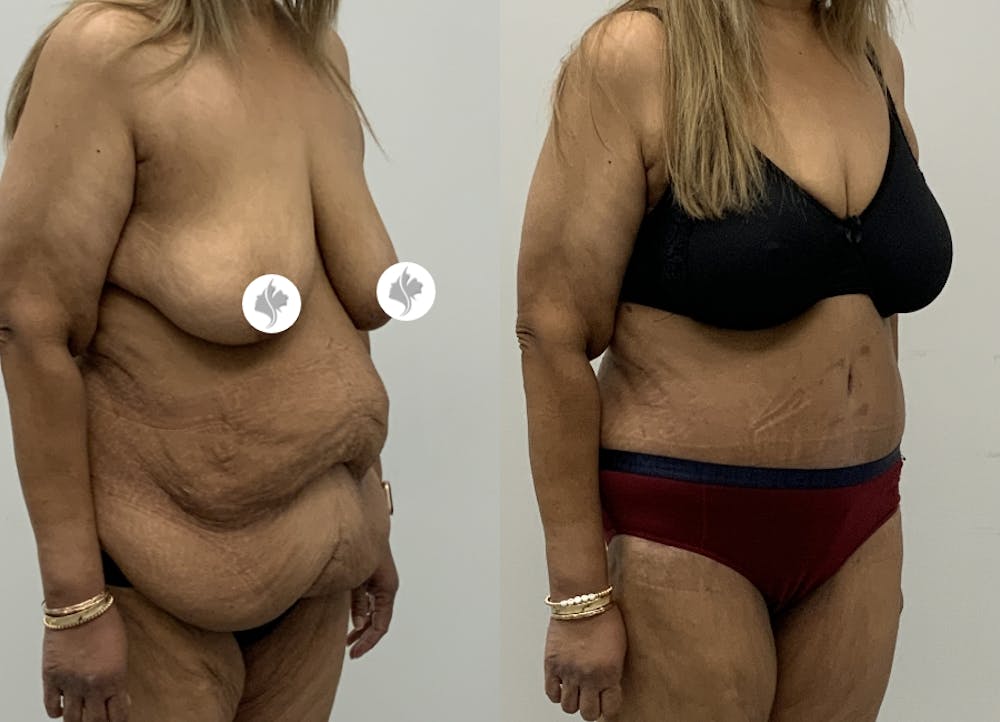 This is one of our beautiful post-bariatric body contouring patient #63