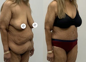 This is one of our beautiful post-bariatric body contouring patient 63