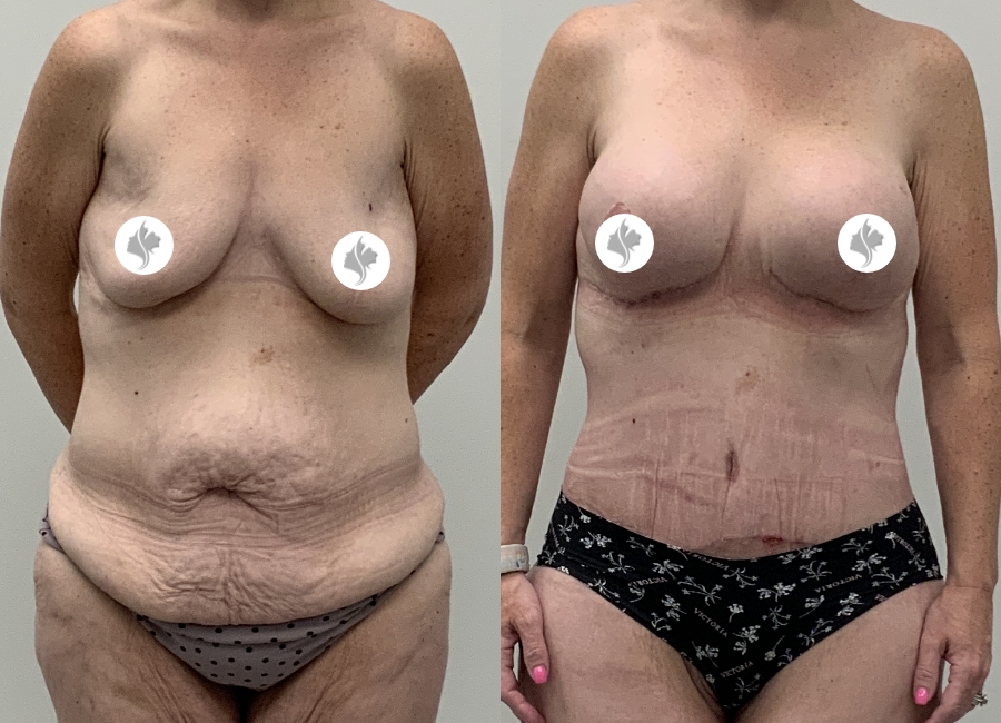 This is one of our beautiful tummy tuck patient 106