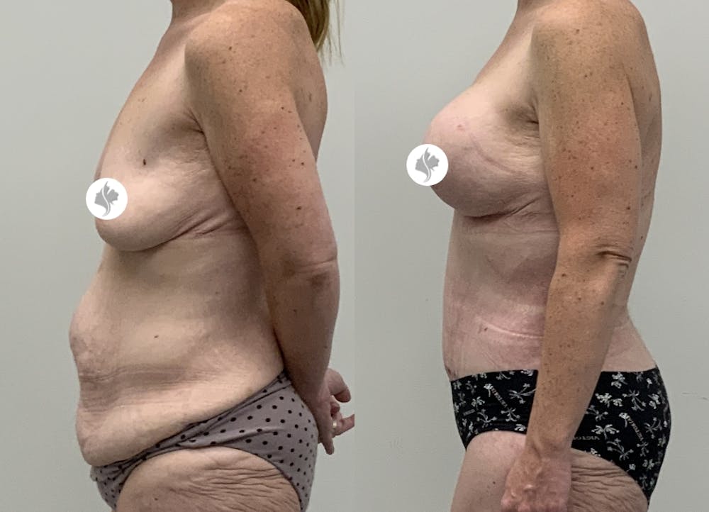 This is one of our beautiful tummy tuck patient #114
