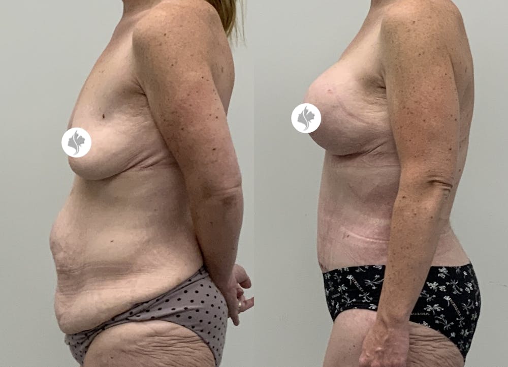 This is one of our beautiful tummy tuck patient #106