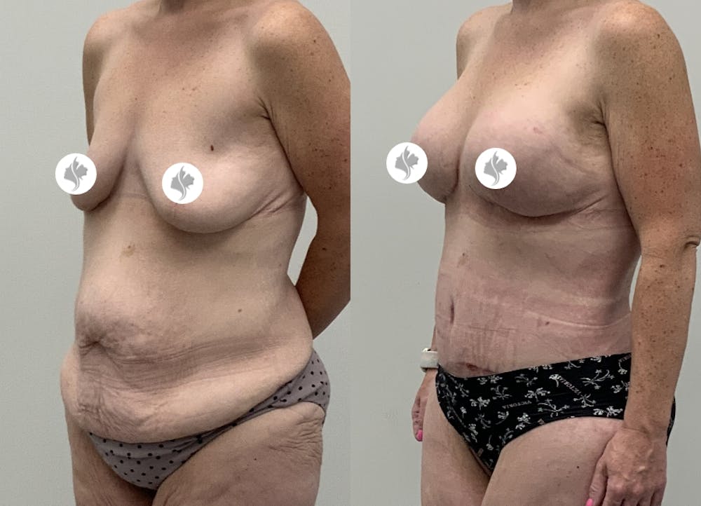 This is one of our beautiful tummy tuck patient #106