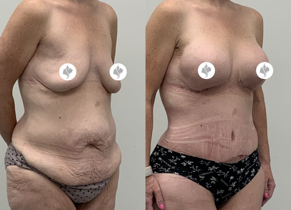 This is one of our beautiful tummy tuck patient #106