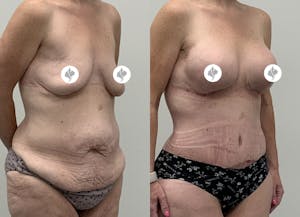 This is one of our beautiful tummy tuck patient 106