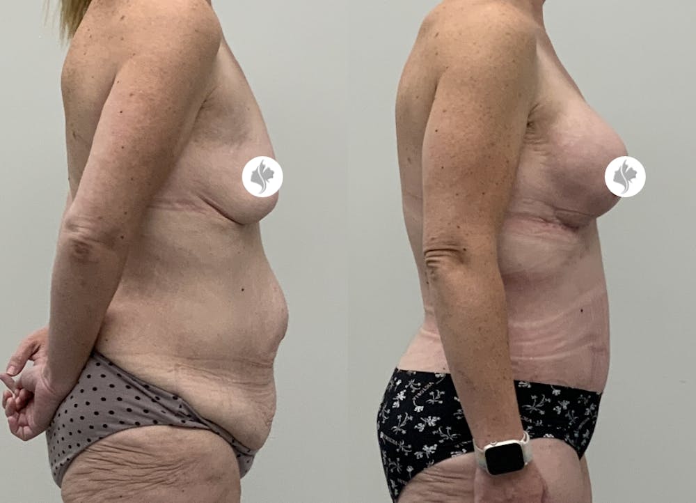 This is one of our beautiful tummy tuck patient #114