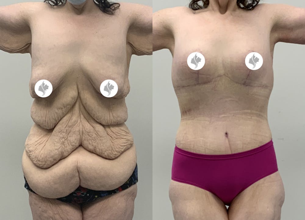 This is one of our beautiful post-bariatric body contouring patient #49