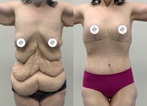 This is one of our beautiful post-bariatric body contouring patient 49