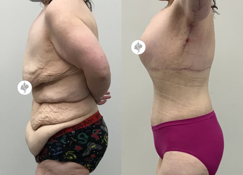 This is one of our beautiful tummy tuck patient #115