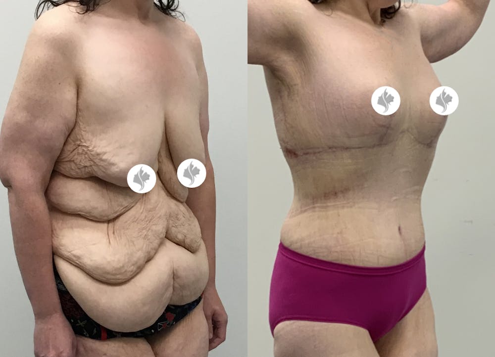 This is one of our beautiful tummy tuck patient #115