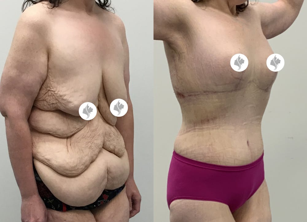 This is one of our beautiful post-bariatric body contouring patient #49