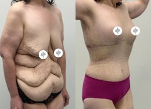This is one of our beautiful post-bariatric body contouring patient 49