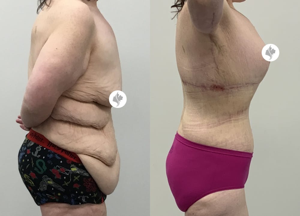 This is one of our beautiful tummy tuck patient #115