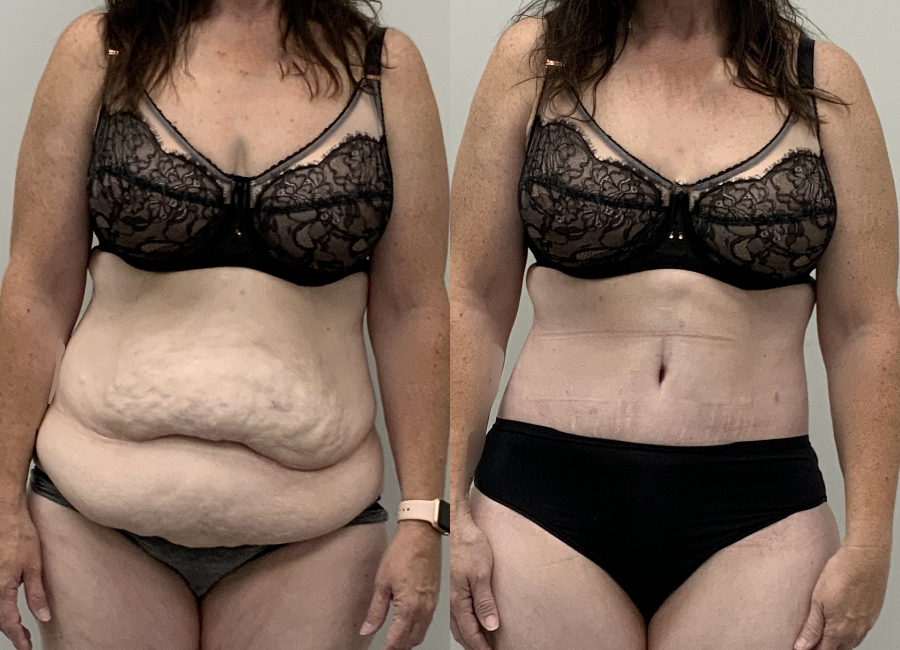 This is one of our beautiful tummy tuck patient 108