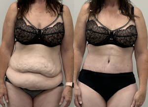 This is one of our beautiful post-bariatric body contouring patient 64